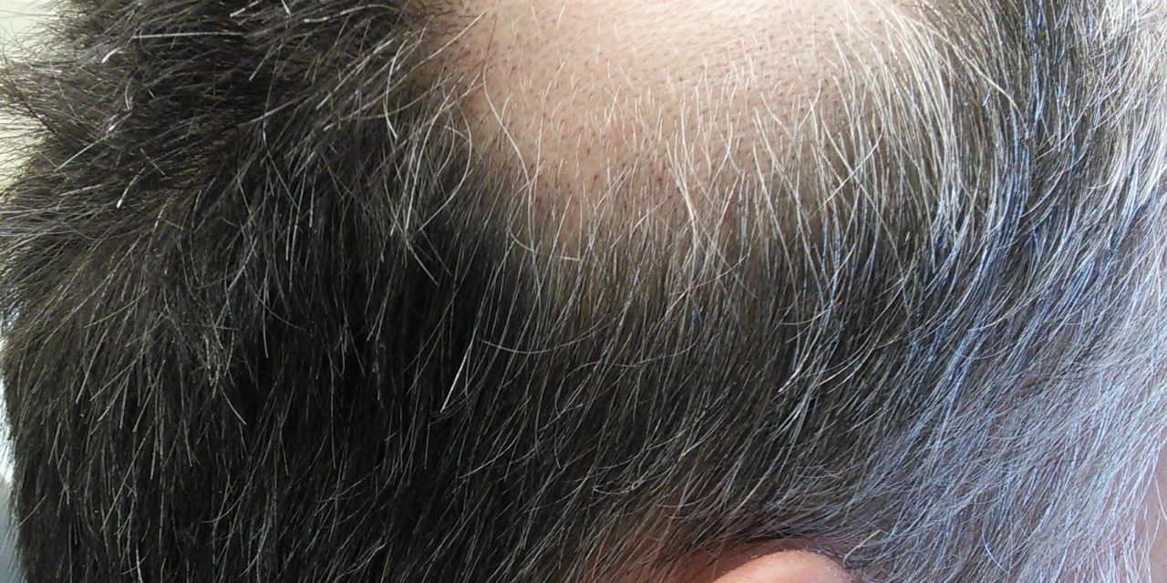 Suplementace vitaminu D může zmírnit vypadávání vlasů